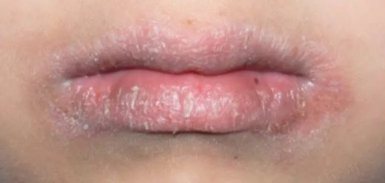 Hình ảnh tổn thương khô nứt bong tróc do chàm môi và viêm môi tại Anh Mỹ Clinic