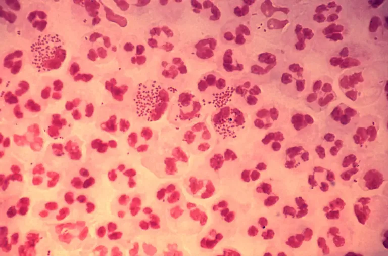 Hình ảnh song cầu khuẩn lậu Neisseria gonorrhoeae bắt màu gram âm dưới kính hiển vi tại Anh Mỹ Clinic
