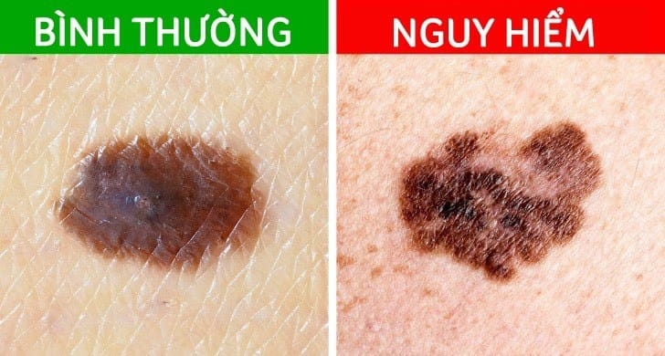 Ảnh đại diện video: Bí Ẩn Phía Sau Nốt Ruồi: Khi Nào Nên Lo Lắng về Ung Thư Melanoma?