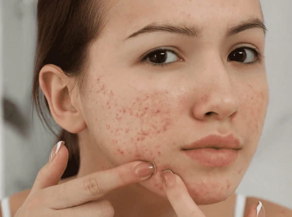 Ảnh đại diện video: Ba Bật Mí Trị Mụn: Lời Khuyên từ chuyên gia da liễu