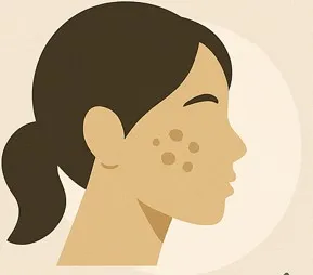 Da người châu Á bị nám