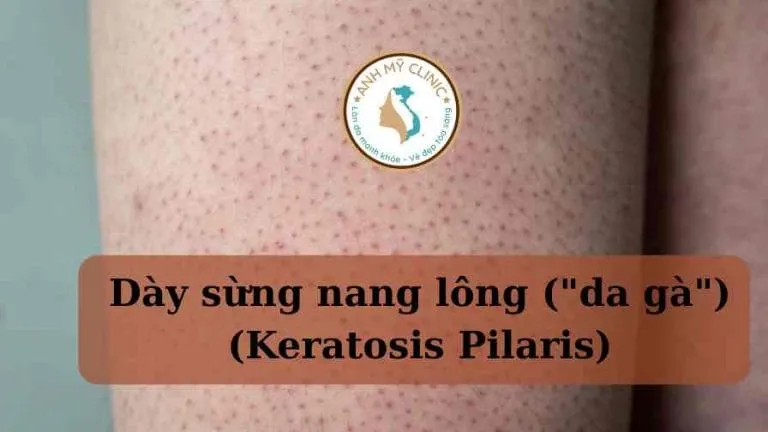 Hình ảnh dày sừng nang lông da gà Keratosis Pilaris tại Anh Mỹ Clinic