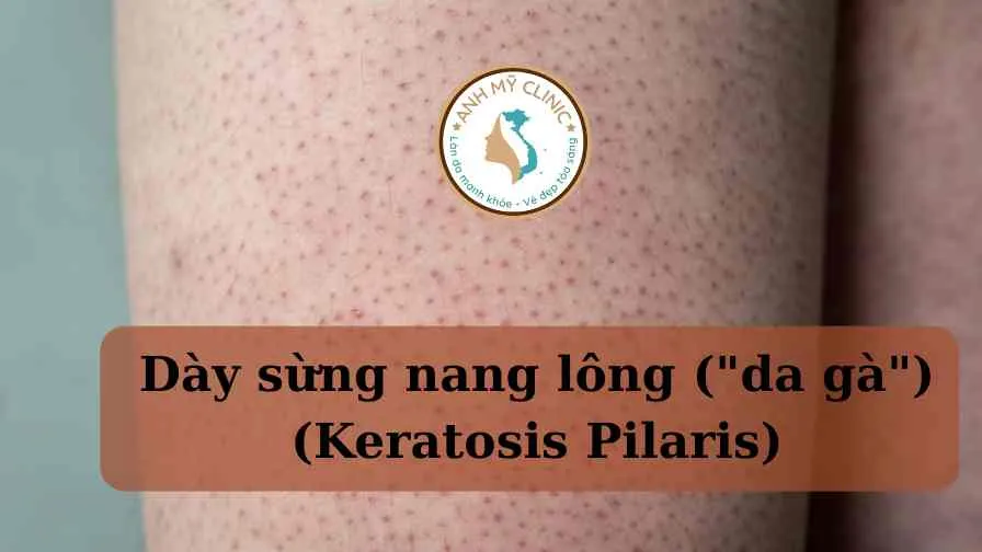 Hình ảnh dày sừng nang lông da gà Keratosis Pilaris tại Anh Mỹ Clinic