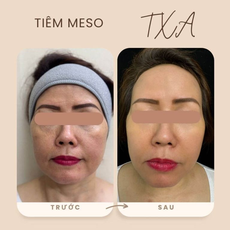 Kết quả tiêm Acid Tranexamic tại Phòng Khám Da Liễu Anh Mỹ Clinic
