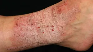 Ảnh đại diện video: Khám Phá Lichen Simplex: Bí Ẩn Về Tình Trạng Da Mạn Tính Ít Ai Biết!