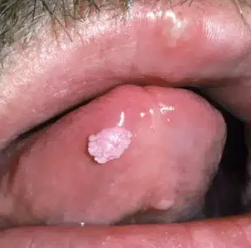 Ảnh đại diện video: Bệnh Mồng Gà: Nguyên Nhân, Triệu Chứng, Điều Trị