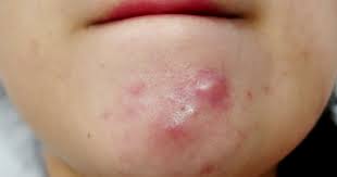 Ảnh đại diện video: Cách Xử Lý Mụn Ở Cằm – Hãy Đối Mặt Với Vấn Đề!