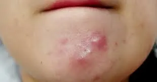 Ảnh đại diện video: Cách Xử Lý Mụn Ở Cằm – Hãy Đối Mặt Với Vấn Đề!