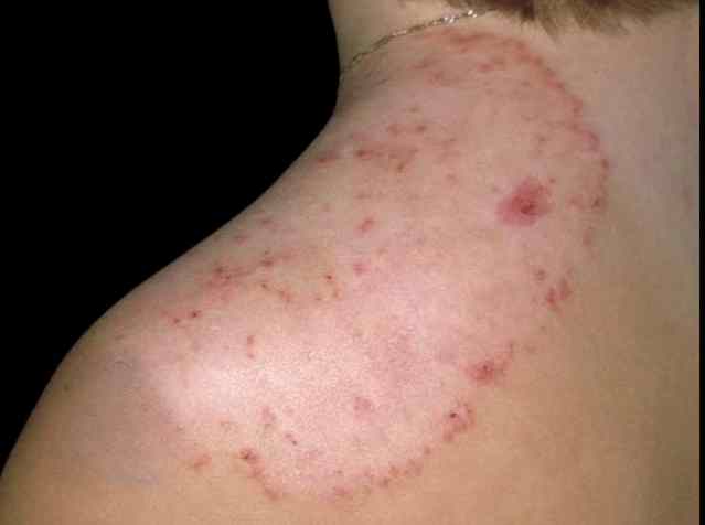 Nấm da hình đồng tiền ở vai