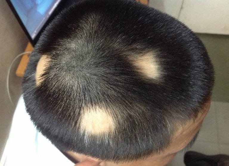 Ảnh đại diện video: Rụng Tóc Từng Vùng: Nguyên Nhân, Triệu Chứng và Giải Pháp Điều Trị