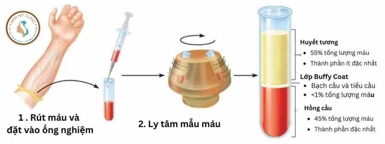 Liệu pháp PRP