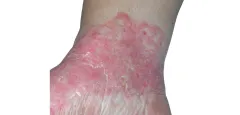 Ảnh đại diện video: Bí Ẩn Tinea Incognito: Nguy Hiểm Khi Dùng Steroid!