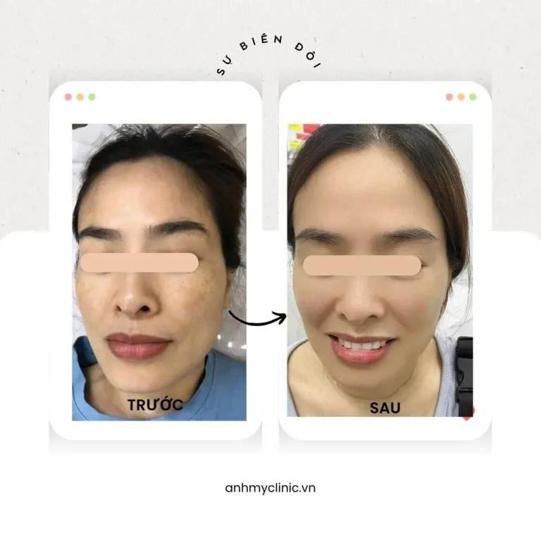 Hiệu quả điều trị nám da bằng laser Nd:YAG tại Phòng Khám Da Liễu Anh Mỹ Clinic TPHCM
