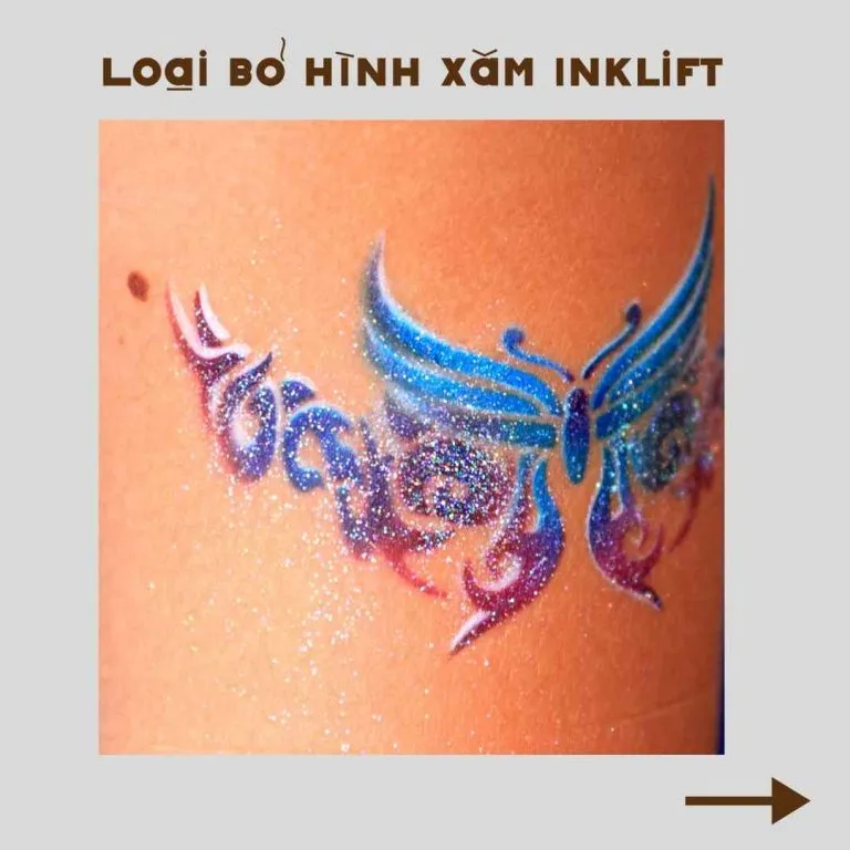 Loại bỏ hình xăm bằng công nghệ InkLift - Anh Mỹ Clinic