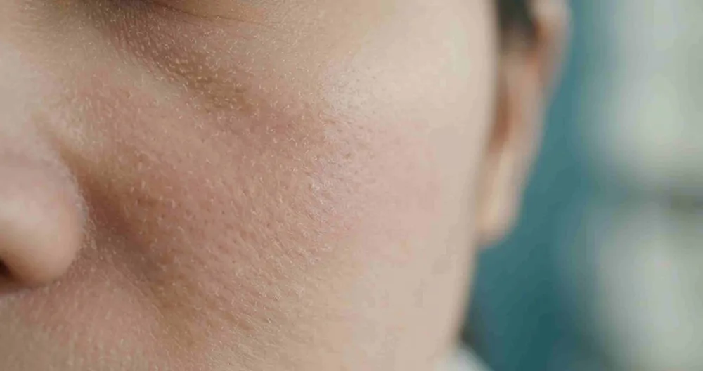 Demodex và rosacea: vảy nang lông quanh chân lông vùng má — dấu hiệu gợi ý mụn khó trị có liên quan Demodex