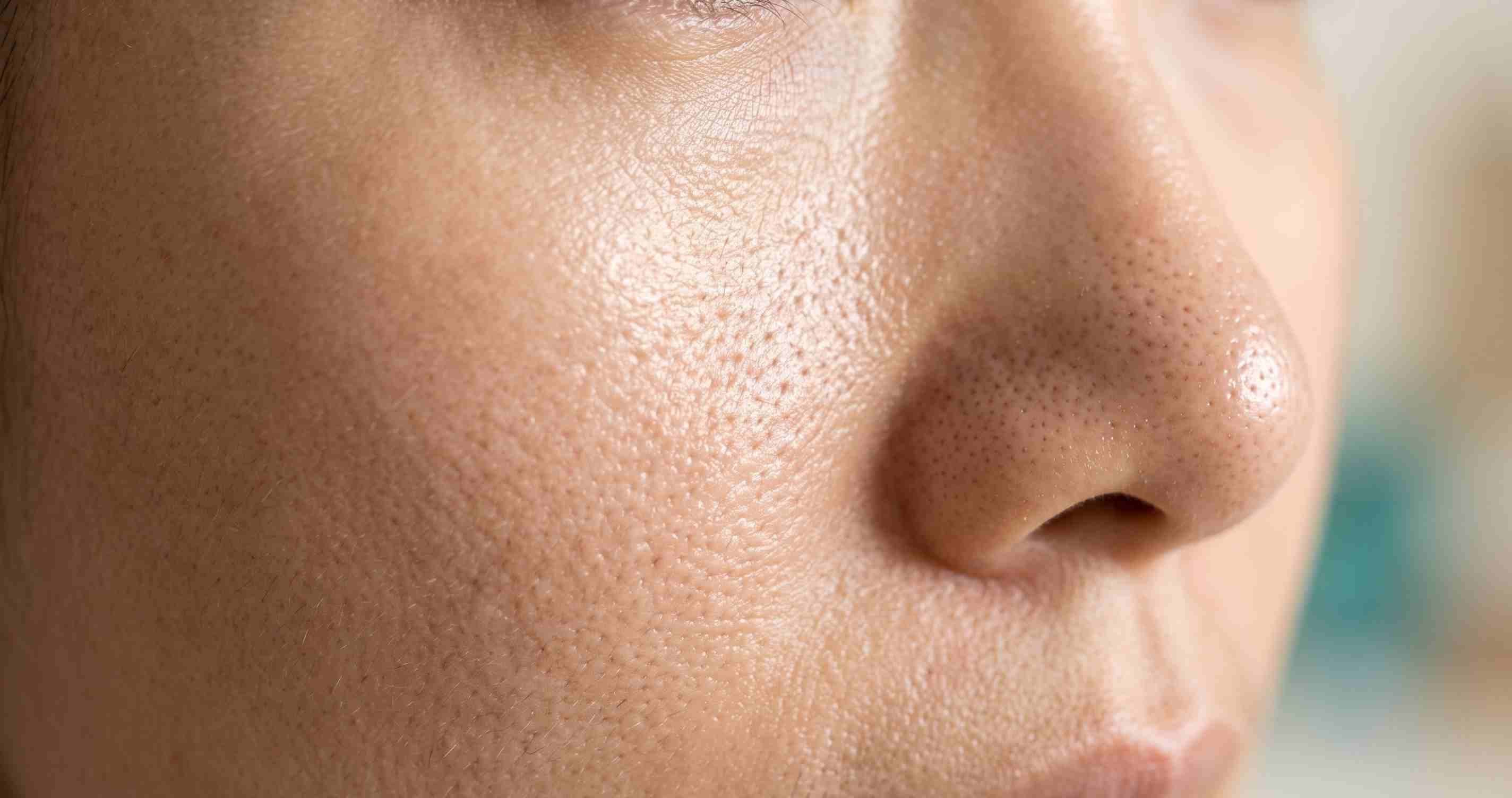 Demodex cư trú trong nang lông tuyến bã ở má, mũi và cằm, vùng da dầu liên quan viêm da do Demodex