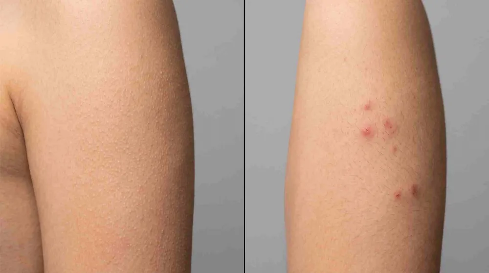 Phân biệt sẩn sừng dày sừng nang lông và sẩn mụn mủ quanh chân lông trên cùng vùng da