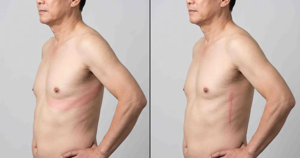 So sánh vệt ban zona theo dải thần kinh một bên và vệt thẳng của viêm da do kiến ba khoang