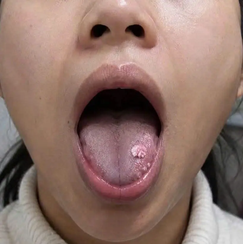 Sùi mào gà ở lưỡi