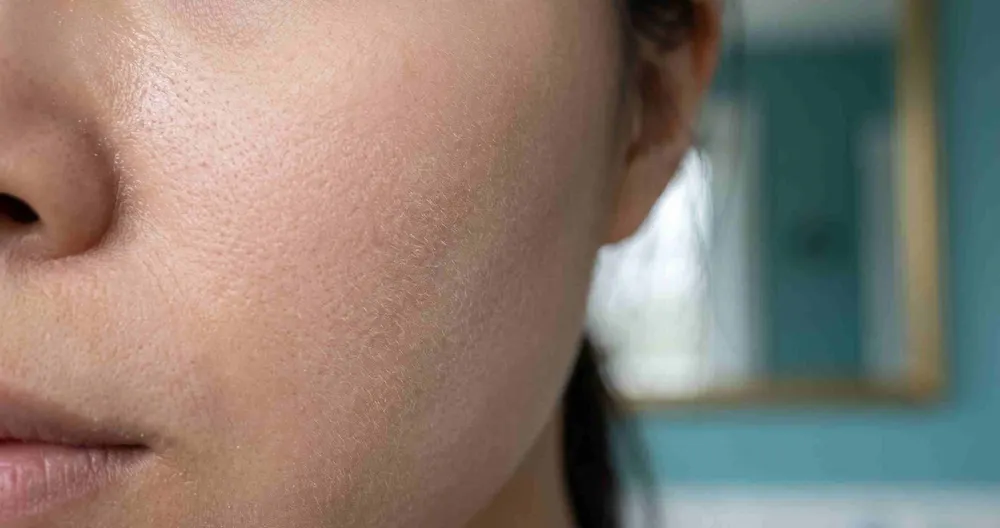 Rửa mặt da dầu mụn đúng cách mùa mưa: chỉ rửa hai lần mỗi ngày và sau khi đổ mồ hôi
