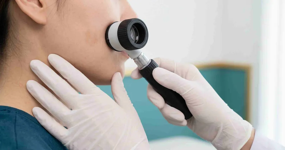 Chẩn đoán và phân loại nám da bằng khám lâm sàng kết hợp dermoscopy tại phòng khám da liễu Anh Mỹ