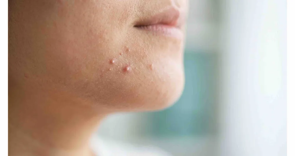 Cơ chế bệnh sinh mụn trứng cá gồm tăng tiết bã nhờn, rối loạn sừng hóa, vi khuẩn C. acnes và viêm