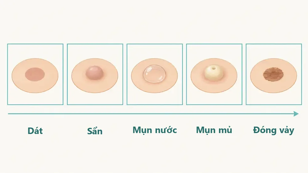 Sơ đồ minh họa 5 giai đoạn nốt đậu mùa khỉ: dát, sẩn, mụn nước, mụn mủ lõm rốn, đóng vảy
