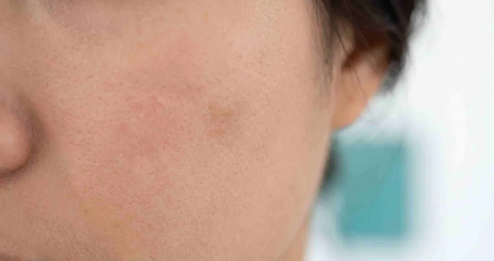 Cận cảnh má có mảng tăng sắc tố nhạt màu nâu, biểu hiện thường gặp của nám da