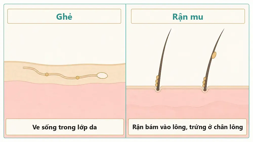 Sơ đồ minh họa ve ghẻ sống trong lớp da và rận mu bám vào sợi lông, hai bệnh ngứa vùng kín khác nhau