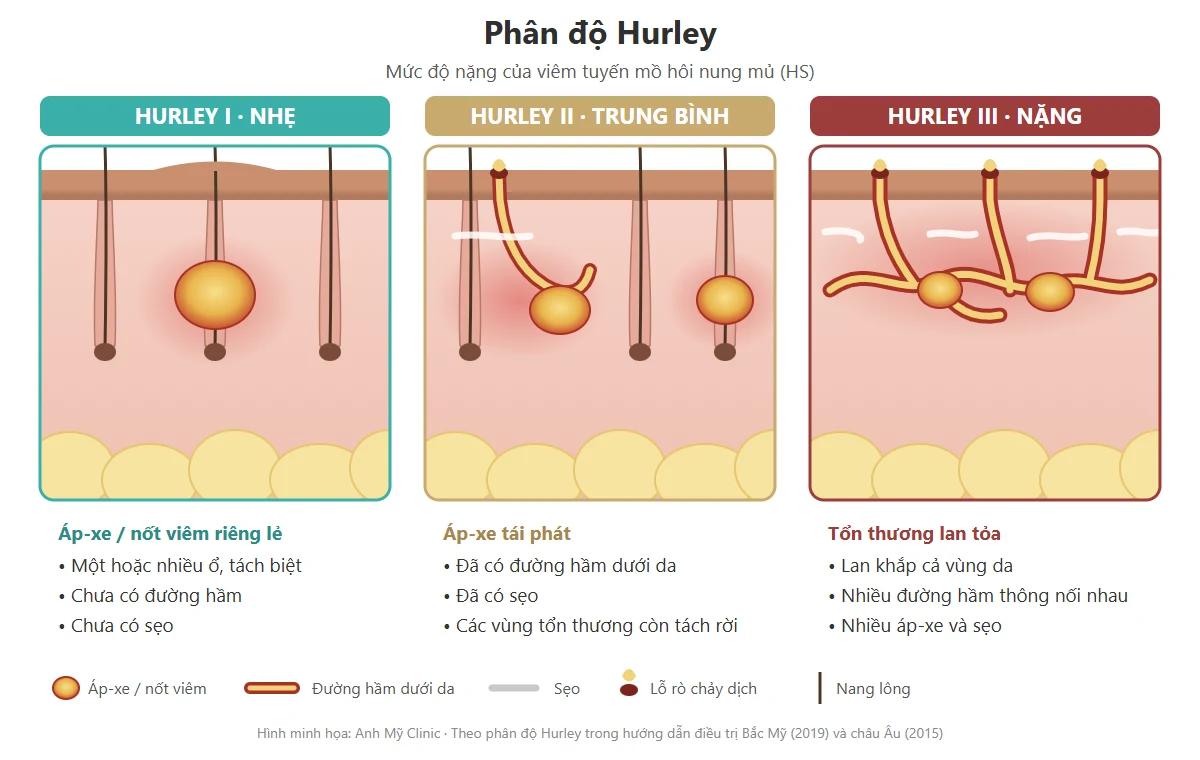 Phân độ Hurley của viêm tuyến mồ hôi nung mủ: Hurley I áp-xe riêng lẻ, Hurley II có đường hầm và sẹo, Hurley III đường hầm lan tỏa thông nối