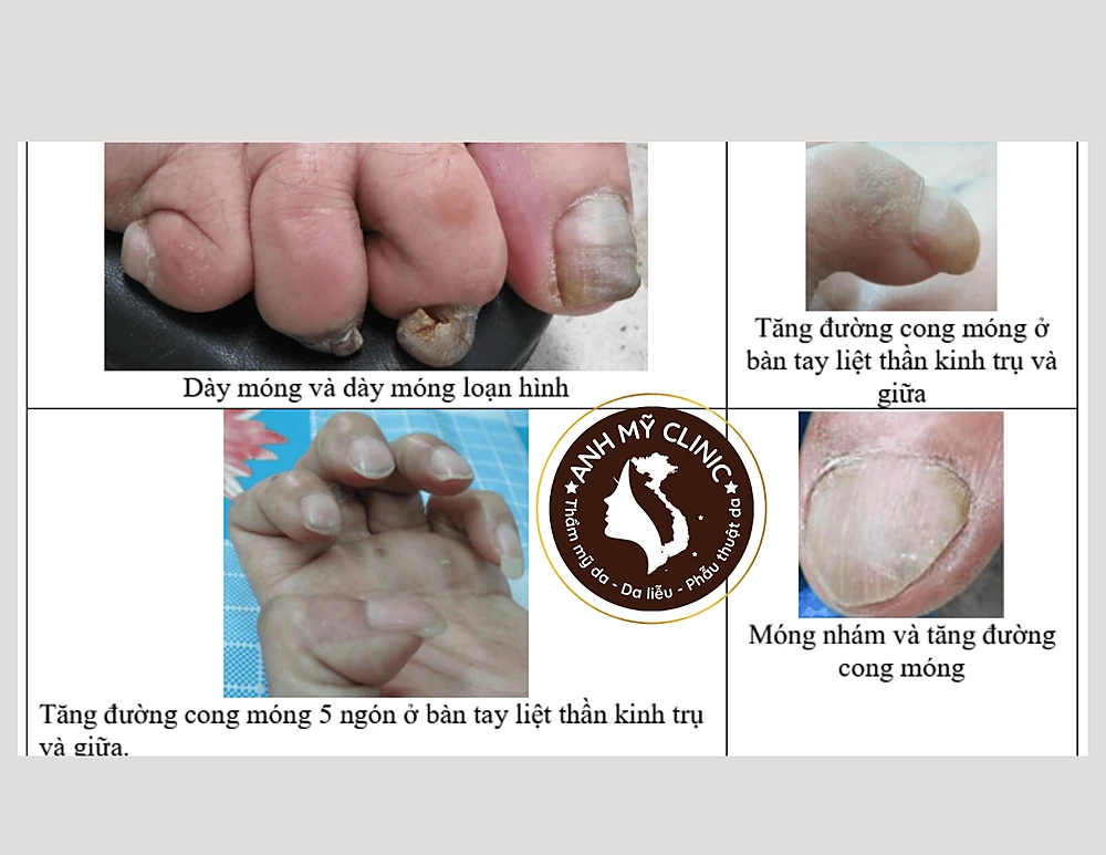 Hình dạng tổn thương móng trong bệnh phong 16