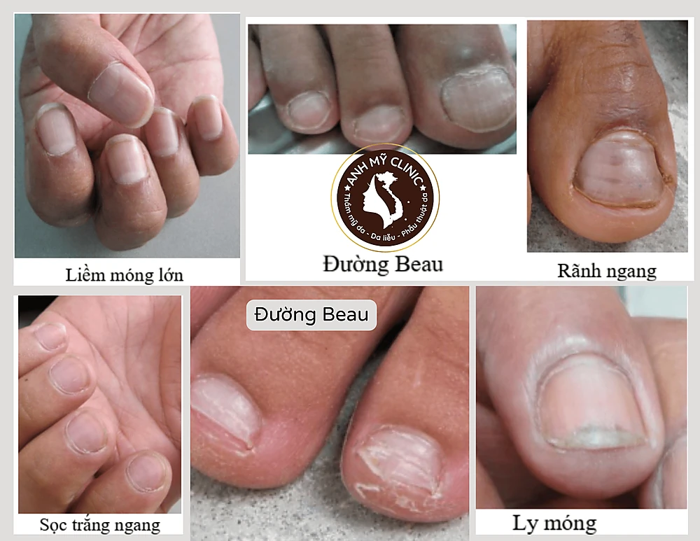 Hình dạng tổn thương móng trong bệnh phong 3