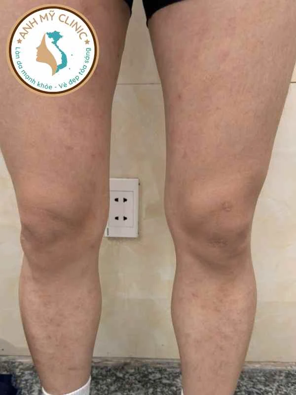 Giang mai 2 ở vủng trước chân
