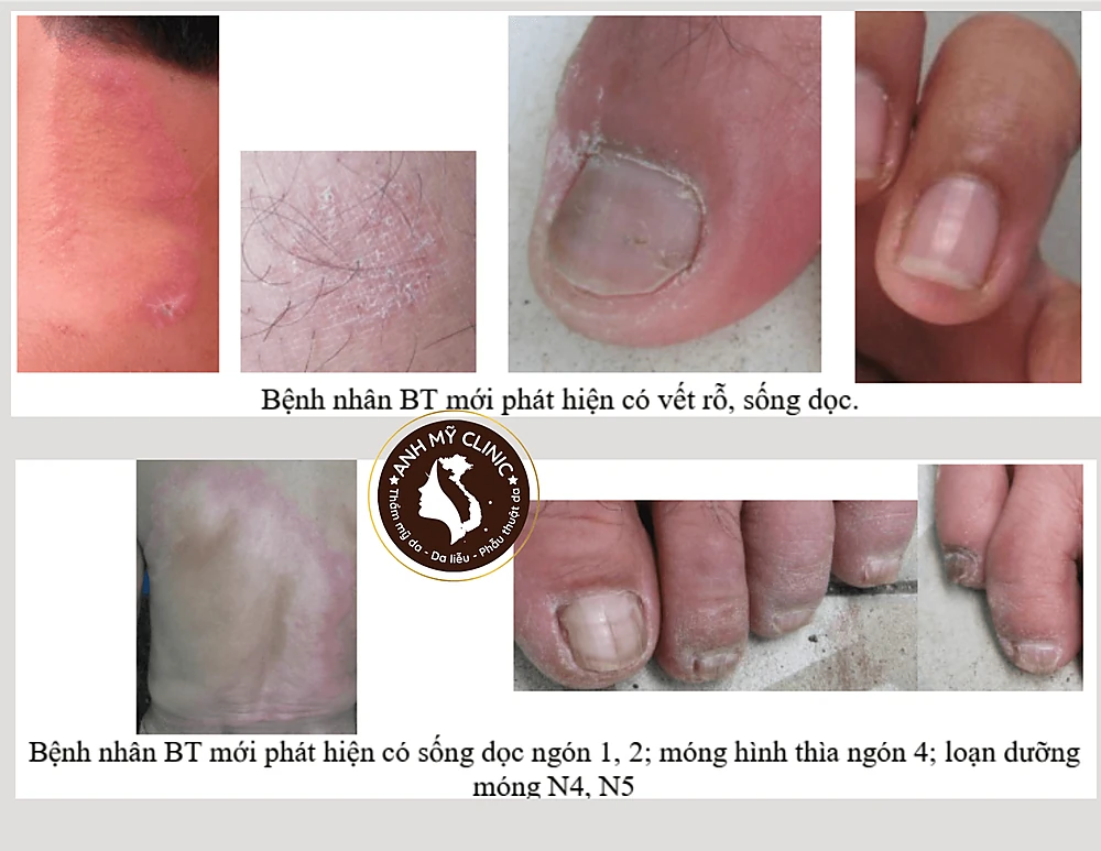 Hình dạng tổn thương móng trong bệnh phong 6