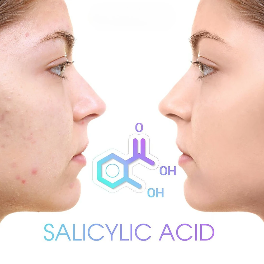 Acid salicylic điều trị mụn