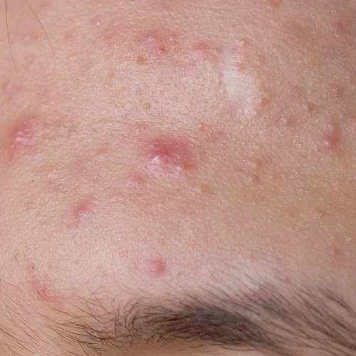 acne-2024.png Mụn trứng cá ở trán