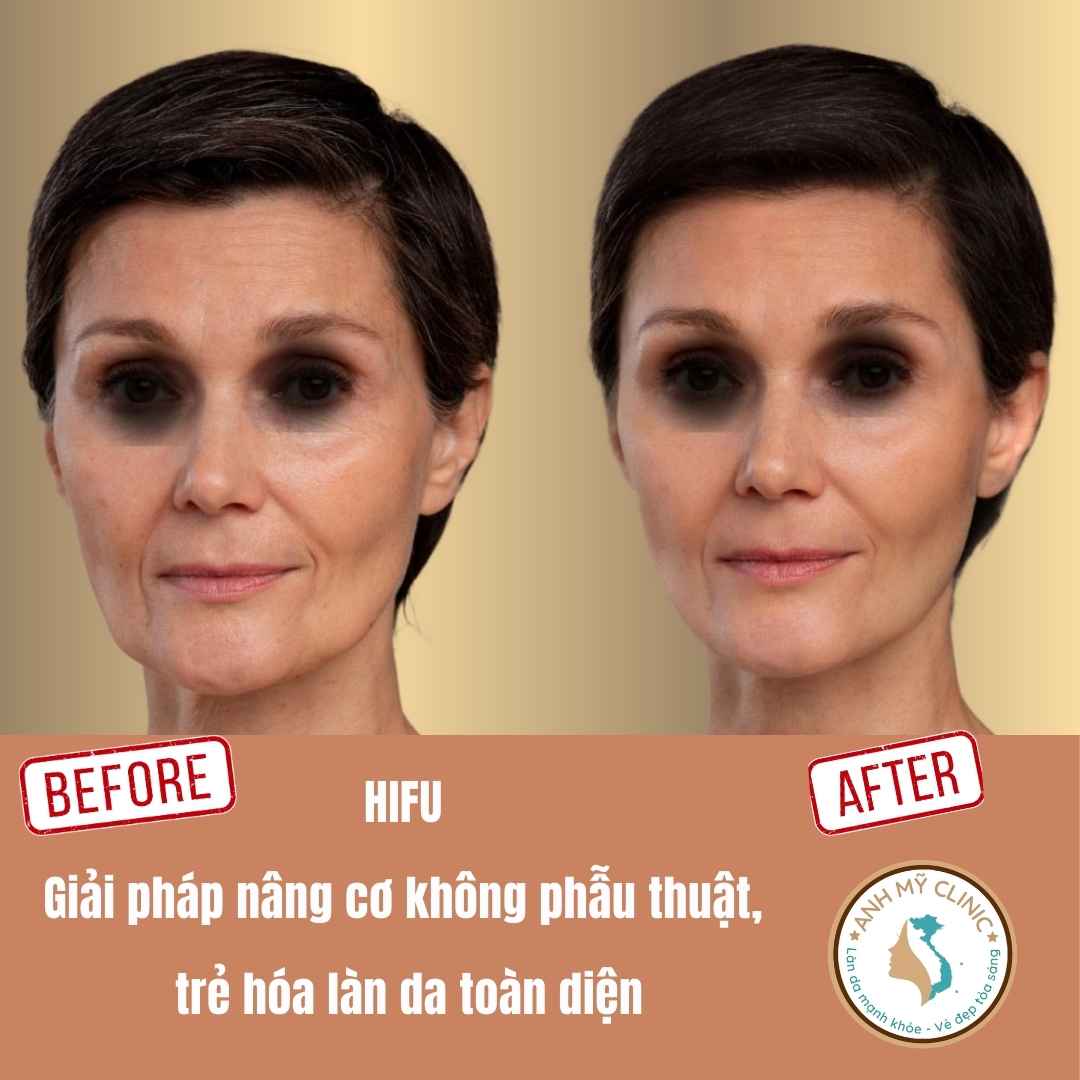 Kết quả HIFU trẻ hóa da nâng cơ tại Anh Mỹ Clinic