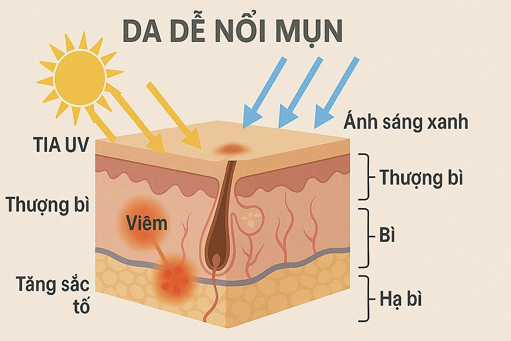 Hình minh họa cho thấy tia UV và ánh sáng xanh gây viêm, oxy hóa và tăng sắc tố trên da mụn.