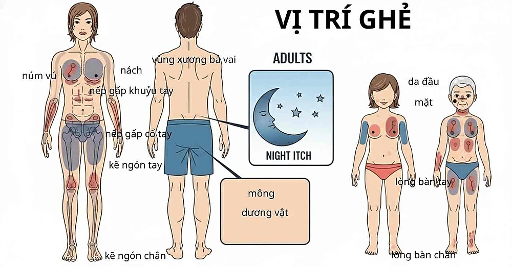 Bản đồ vị trí tổn thương bệnh ghẻ ở người lớn và trẻ nhỏ