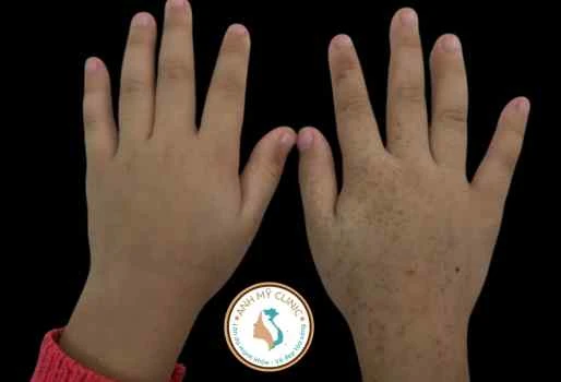 Viêm da tiếp xúc ánh sáng do xịt nước hoa