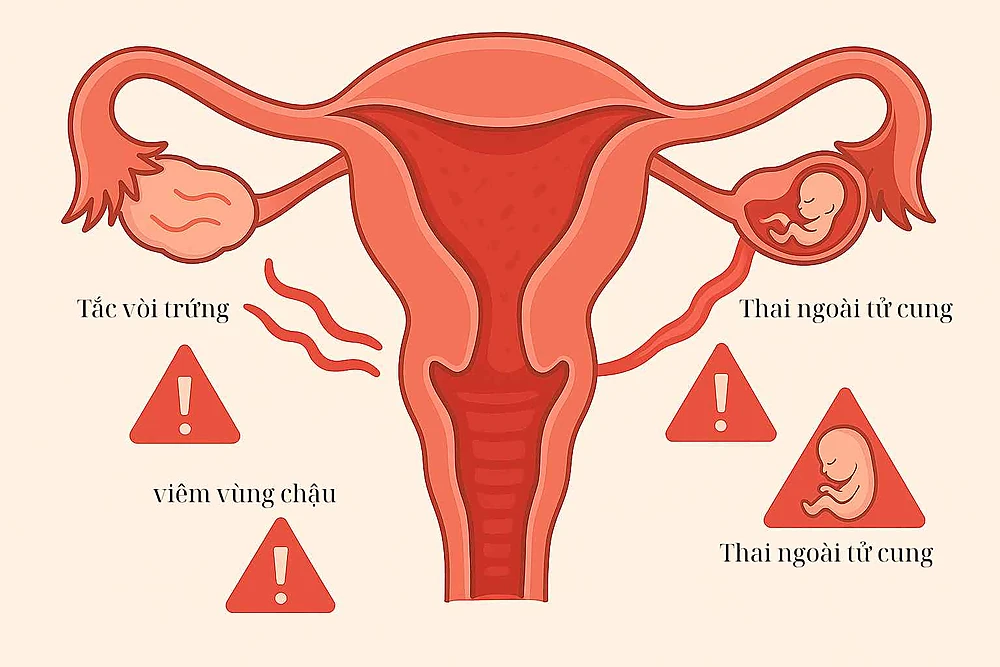 Biến chứng: PID, thai ngoài tử cung