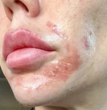 Bỏng sau peel da