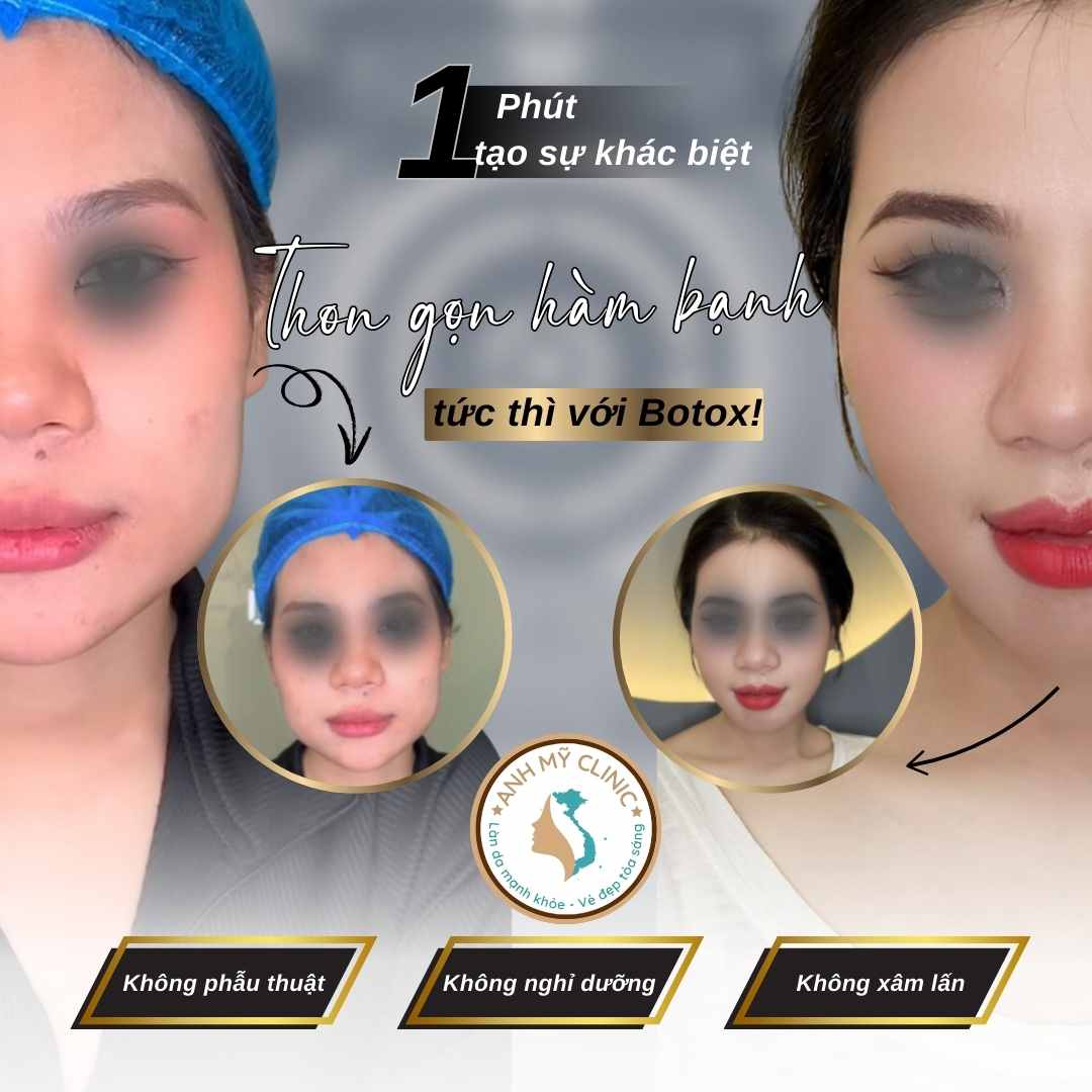 Botox thon gọn góc hàm tại Anh Mỹ Clinic