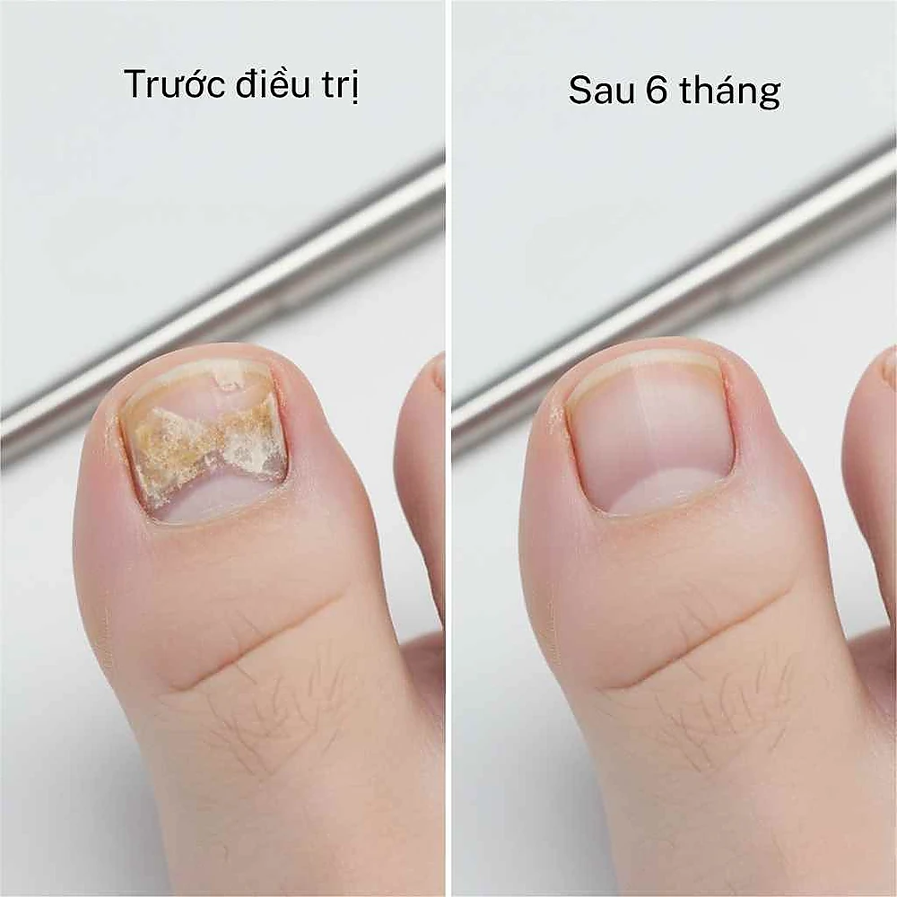 Hình trước và sau điều trị nấm móng tại Phòng Khám Da Liễu Anh Mỹ – phục hồi móng trong, khỏe, không tái phát.