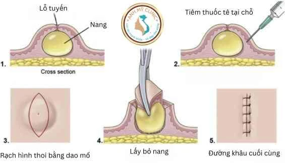 Các bước cắt bỏ u nang biểu bì