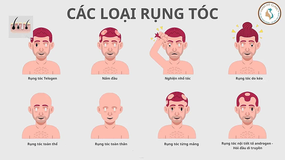 Các loại rụng tóc