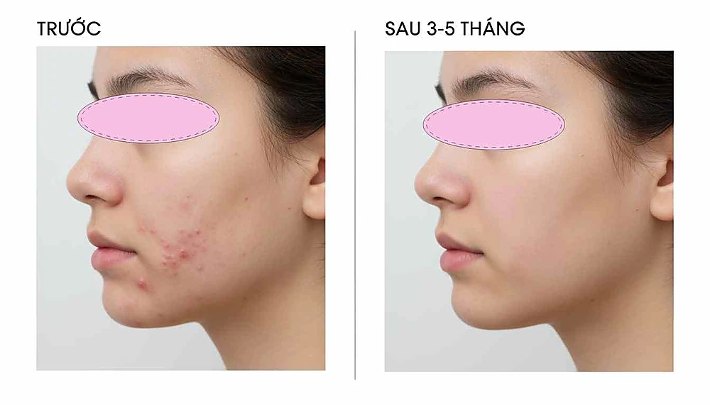 Hình before–after mô tả hiệu quả điều trị mụn nội tiết tuổi dậy thì nữ bằng spironolactone tại Anh Mỹ Clinic.