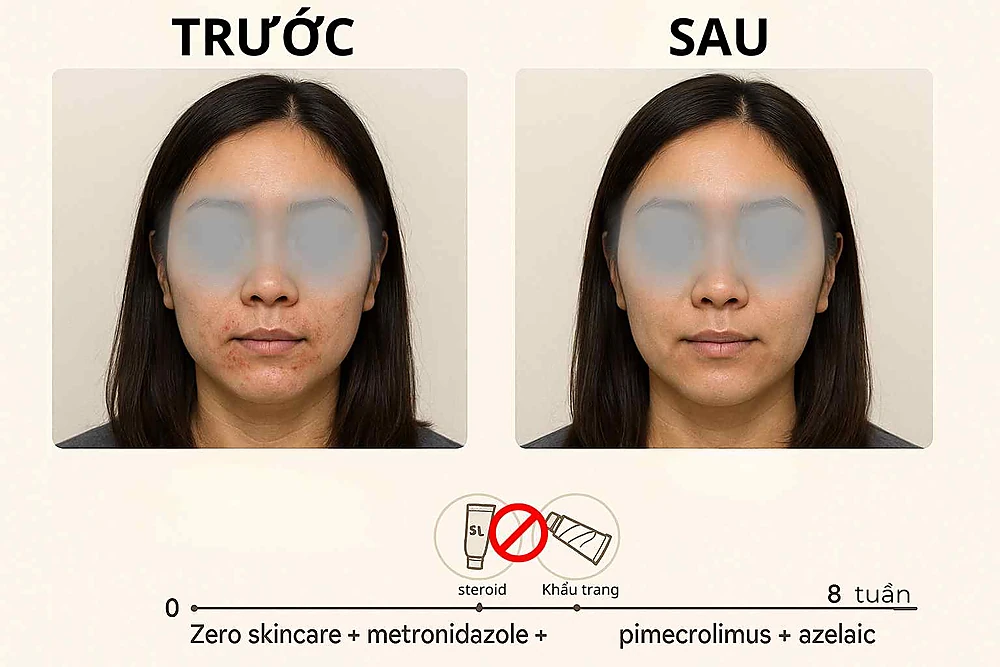 Ca nữ 28 tuổi viêm da quanh miệng: trước điều trị có sẩn li ti chừa viền môi; sau 8 tuần với zero skincare, metronidazole, pimecrolimus và azelaic, tổn thương cải thiện ~90%.