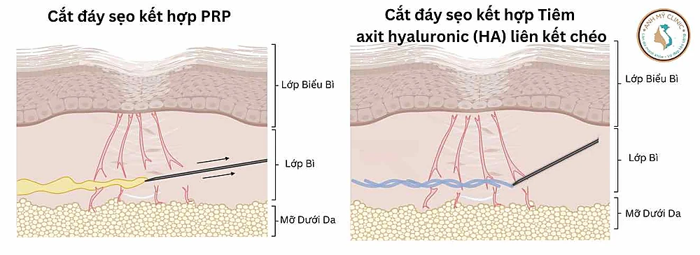 Cắt đáy sẹo kết hợp PRP / HA
