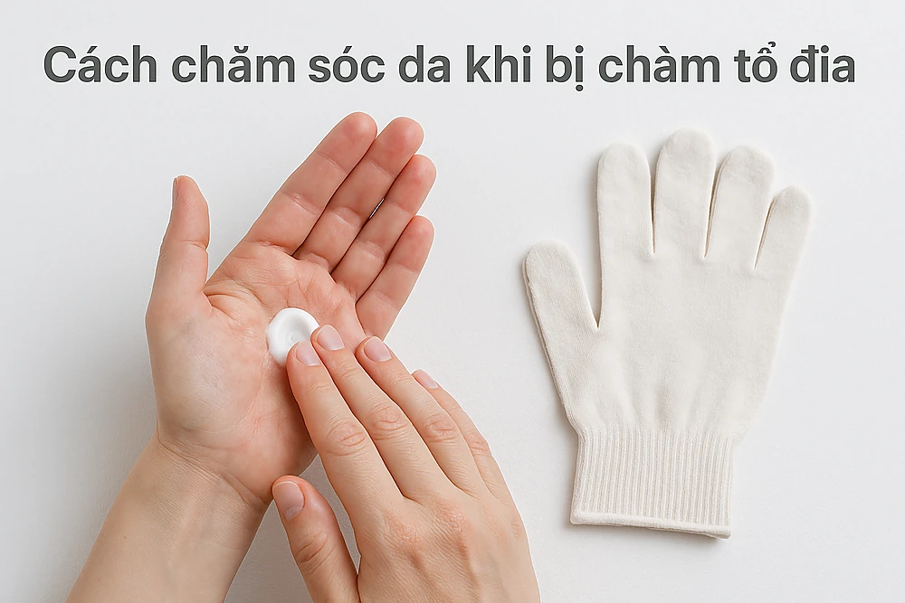 Hình ảnh bệnh nhân bôi kem dưỡng ẩm và đeo găng cotton để bảo vệ da khi bị chàm tổ đỉa.